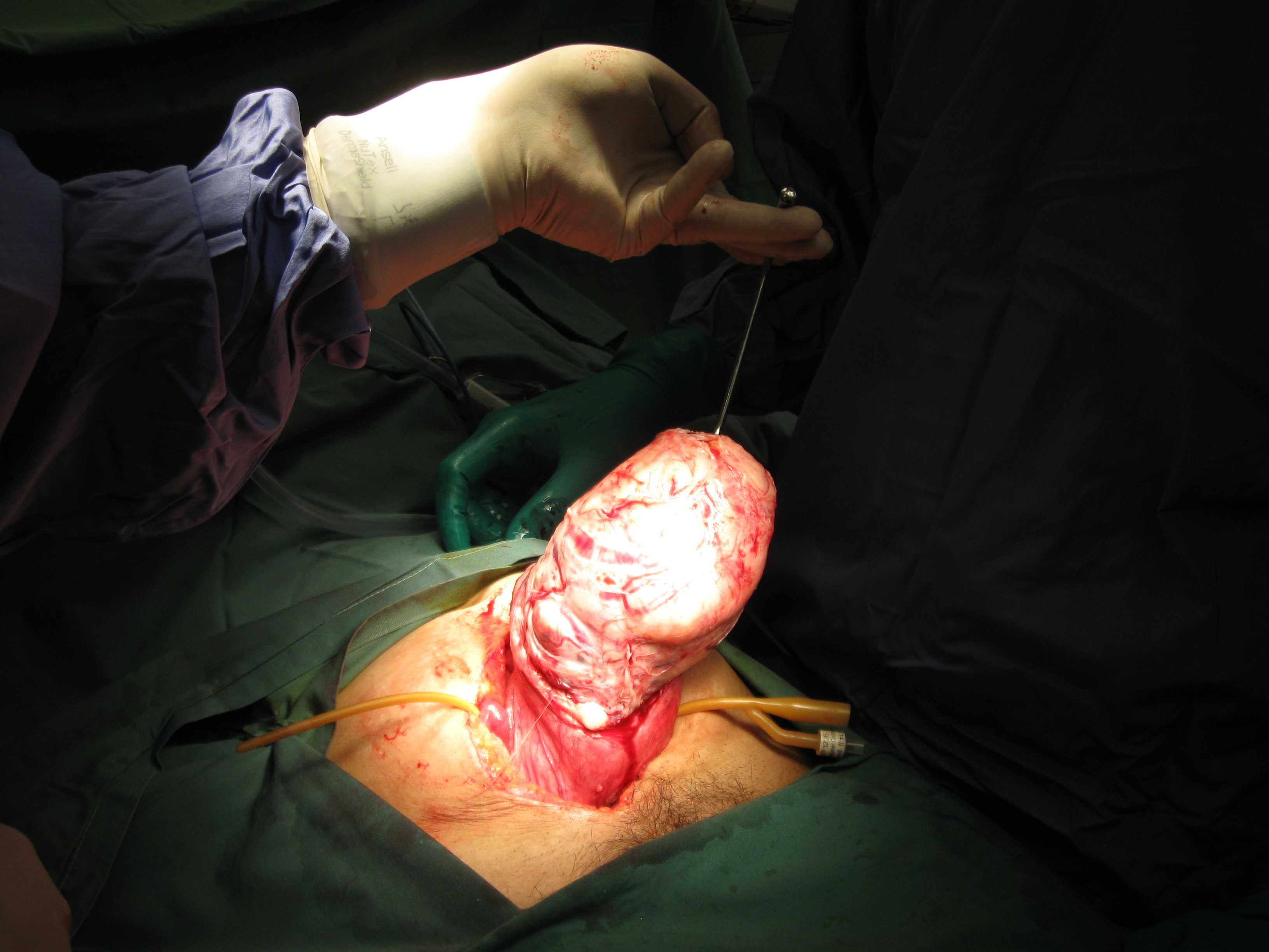 Fibroid Abdominal Myomectomy Serag Youssif (10)